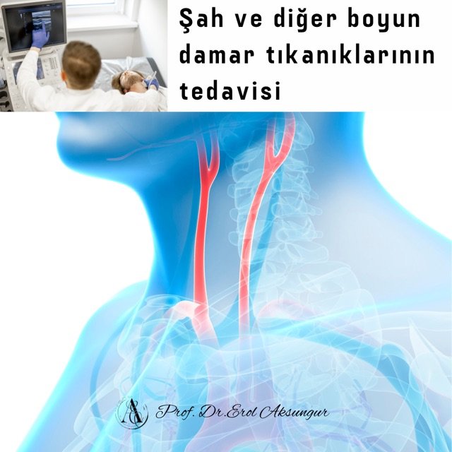 Şah ve diğer boyun damarı tıkanıklarının tedavisi