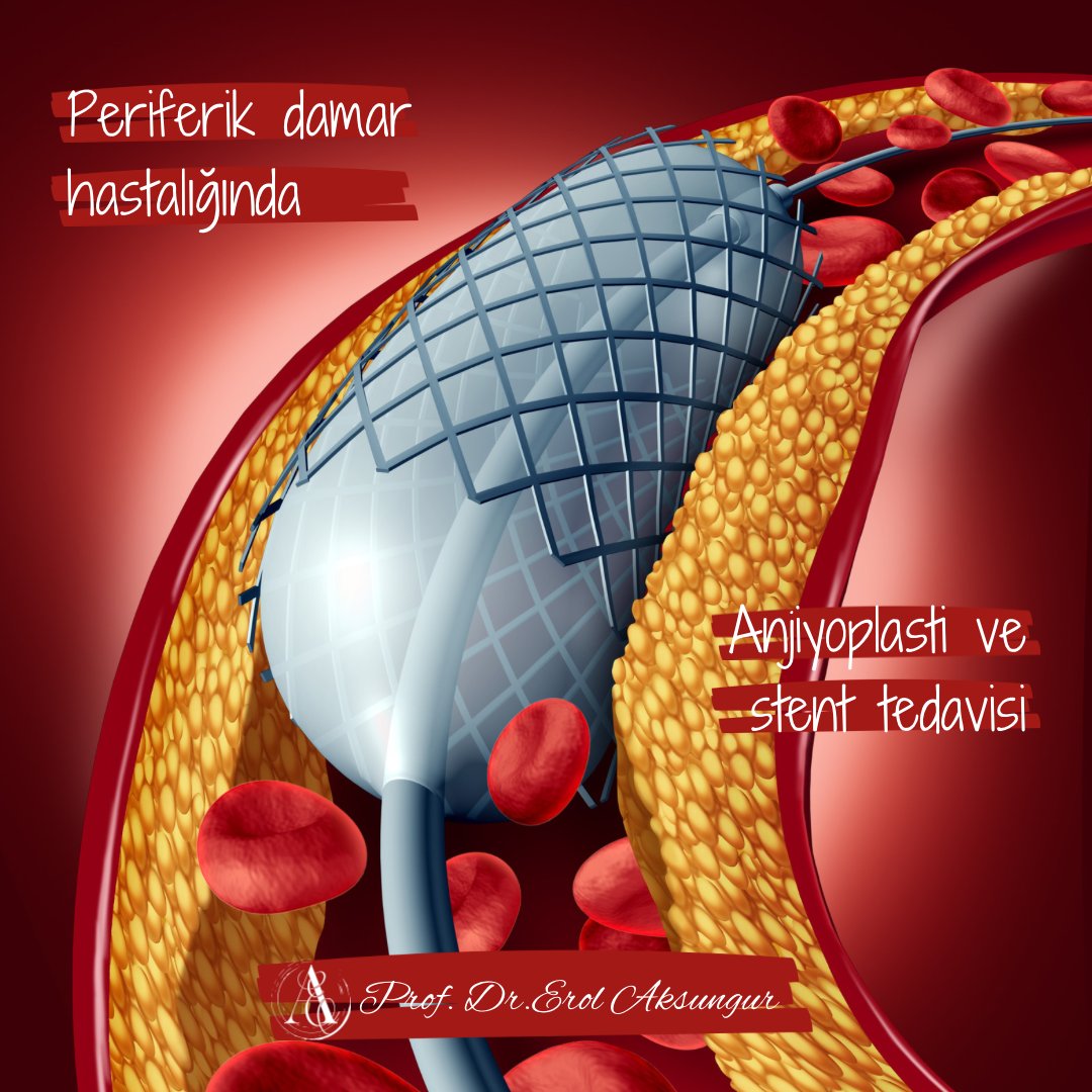 Periferik arter hastalığı tedavileri
