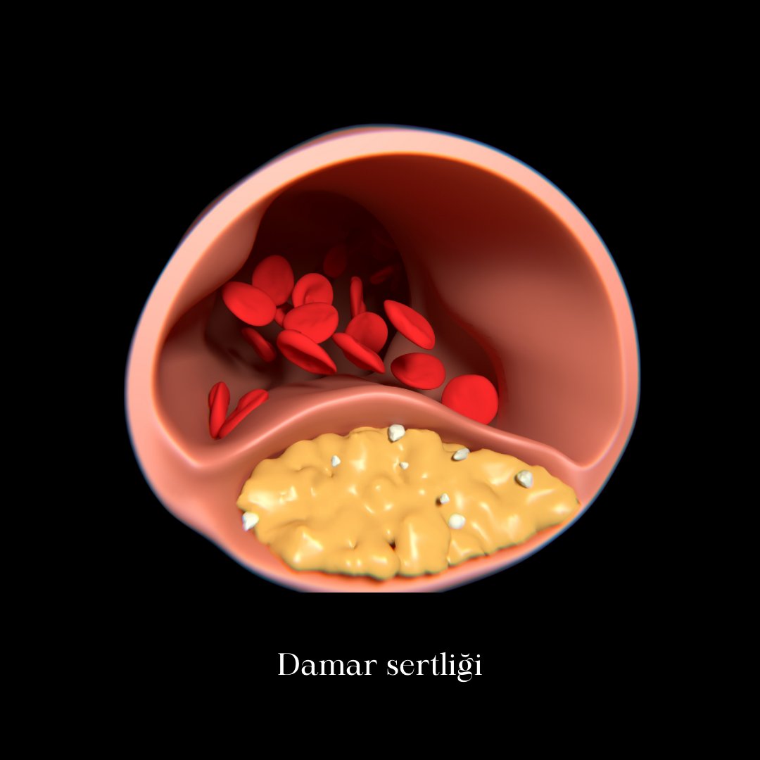 Damar sertliği nedir?