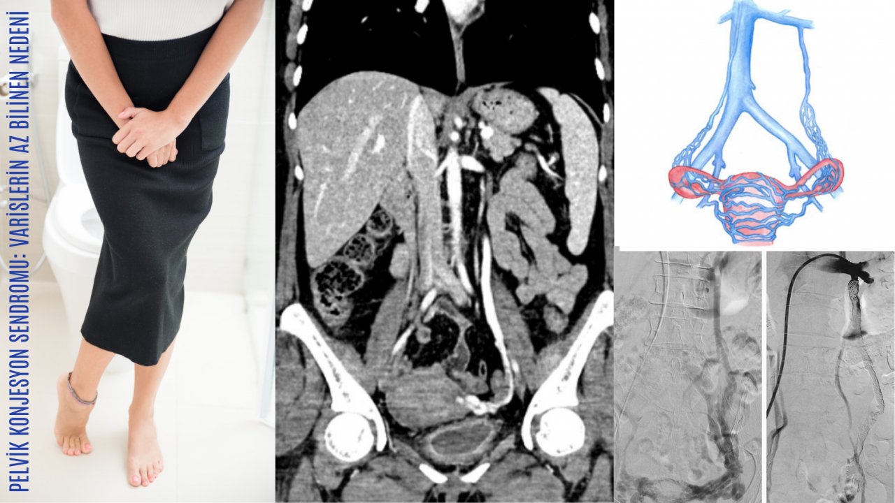 Pelvik Konjesyon Sendromu: Kadınlarda Varis Oluşumuna Nasıl Yol Açar?