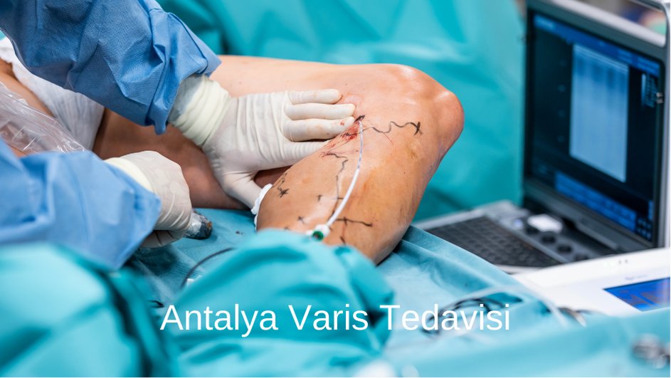 Antalya Varis Tedavisi